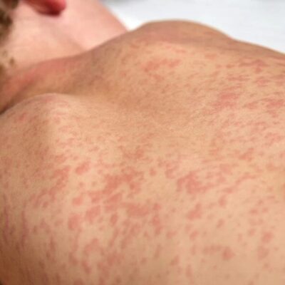 Brasil soma 37 casos de sarampo neste ano e reforça vacinação em meio à alta