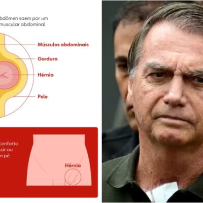 Bolsonaro passa por cirurgia bem-sucedida para correção de hérnia bilateral