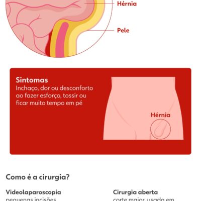 Bolsonaro será operado para corrigir hérnia inguinal bilateral, explica condição