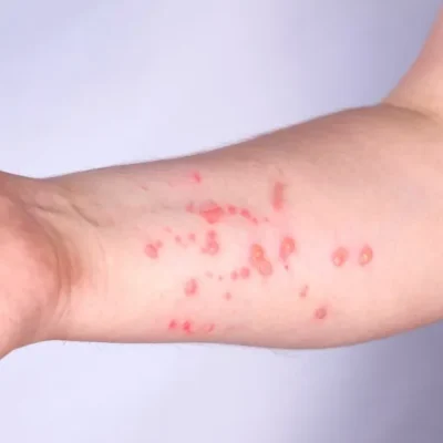 Paciente de 19 anos está isolada por suspeita de monkeypox em Mossoró