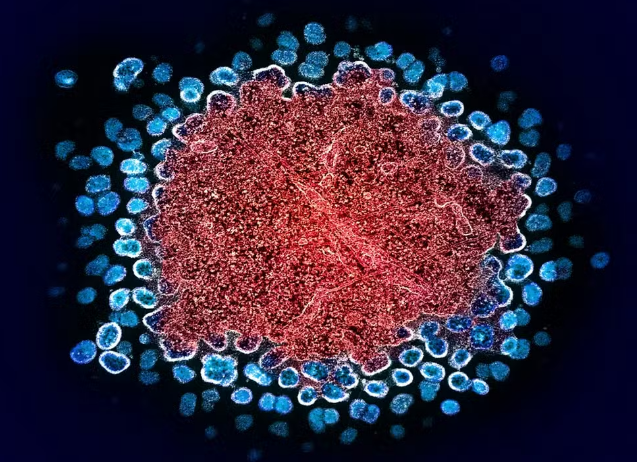 Paciente norueguês alcança remissão do HIV após transplante de medula óssea